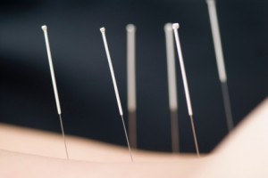 Acupuncture is an ancient medical art that is over 5000 years old. Very fine needles are inserted through the skin to influence the physiological function of the bod